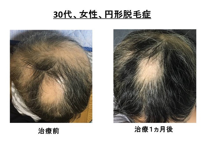 円形脱毛症　病院